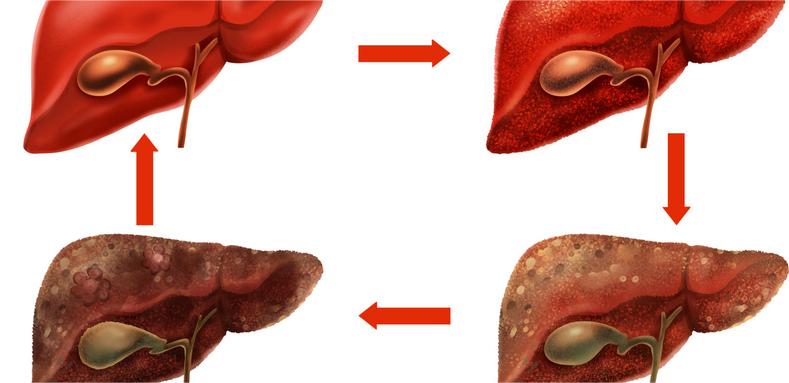 摄图网_401806707_wx_乙肝肝脏病变症状医疗插画（企业商用） (1).jpg