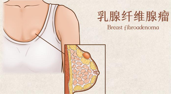 摄图网_401789492_乳腺纤维腺瘤医疗插画示意图(企业商用).jpg